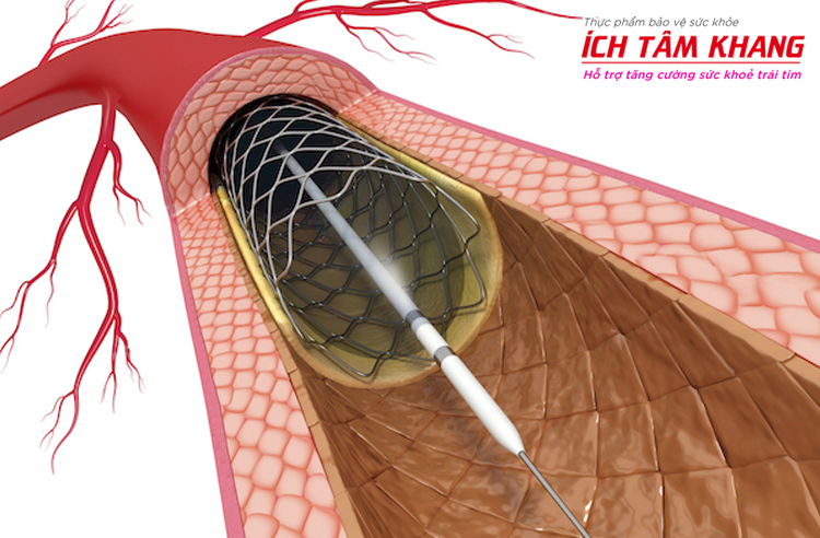 Can thiệp đặt stent được thực hiện khi mức độ hẹp mạch vành lớn, mảng xơ vữa dễ nứt vỡ